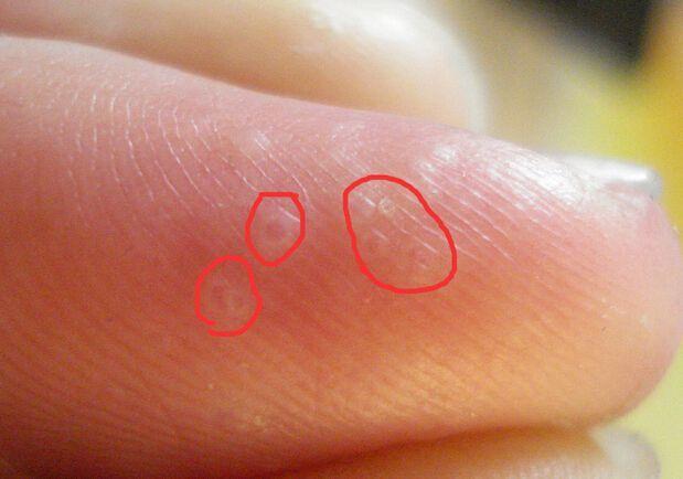 夏天手上长出好多小水泡,奇痒难耐,到底是怎么回事?
