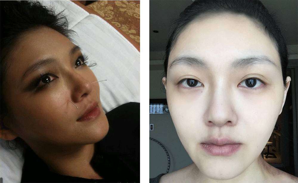 (左边是做脸灸,仅作肤色对比用)韩国的美白针以大韩维生素研究会的