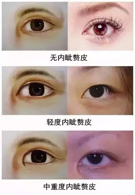 我只想安安静静地割个双眼皮,为嘛老让我开眼角?