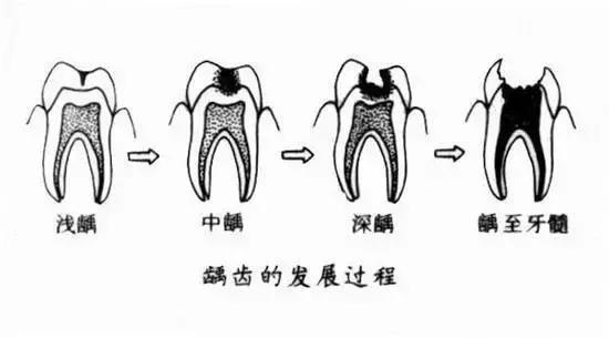 小朋友吃多了糖牙齒裡真的會長蟲嗎怎麼讓它不長蟲呢