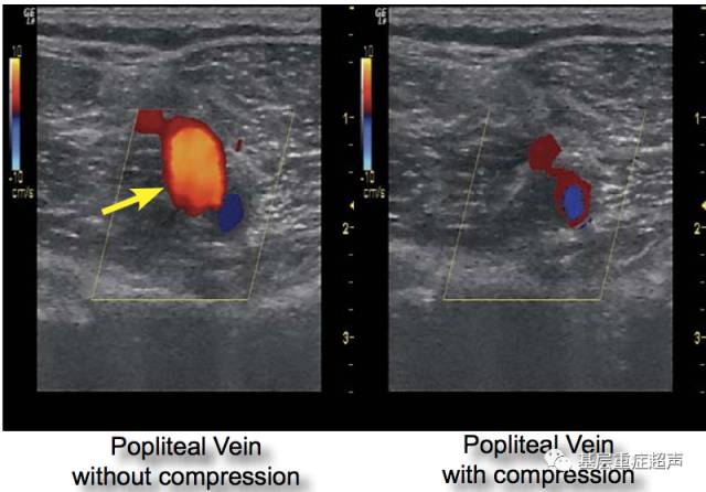 在腘窝处横向放置探头,可观察到与腘动脉及腘静脉.
