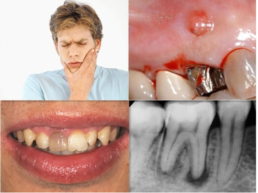 4 什么原因会造成牙神经及牙髓组织的破坏?