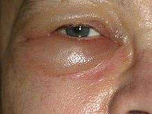 早发现 如此常见小问题都是慢性肾病症状 希望没有你