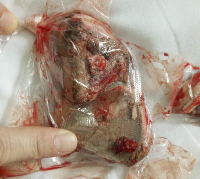 常德老太长期使用尿不湿,原来是膀胱内"鹅蛋"在作祟!