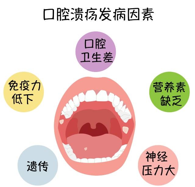 你還以為口腔潰瘍是因為上火嗎?