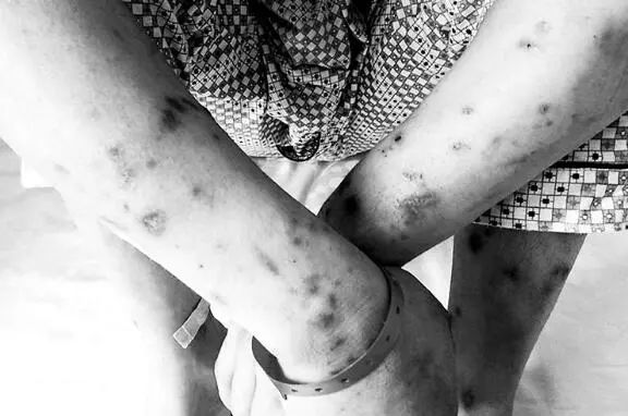 受到污染,特别是开放性骨折,含铁锈的伤口,伤口小而深的刺伤,盲管外伤