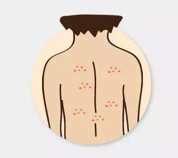 痘痘告诉你,身体哪里生病了——韩式皮肤管理