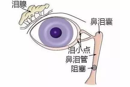 但是对于泪道不通的孩子来说,瞬目时产生的眼泪无法正常排出,眼睛便会