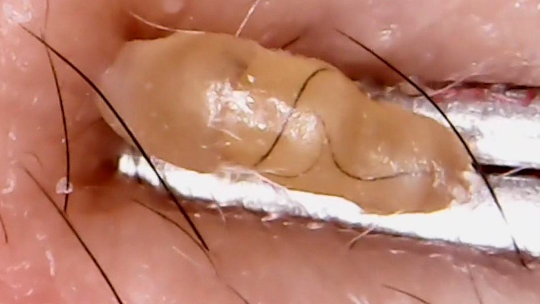 超大只黑头 非常艰难才挤出来