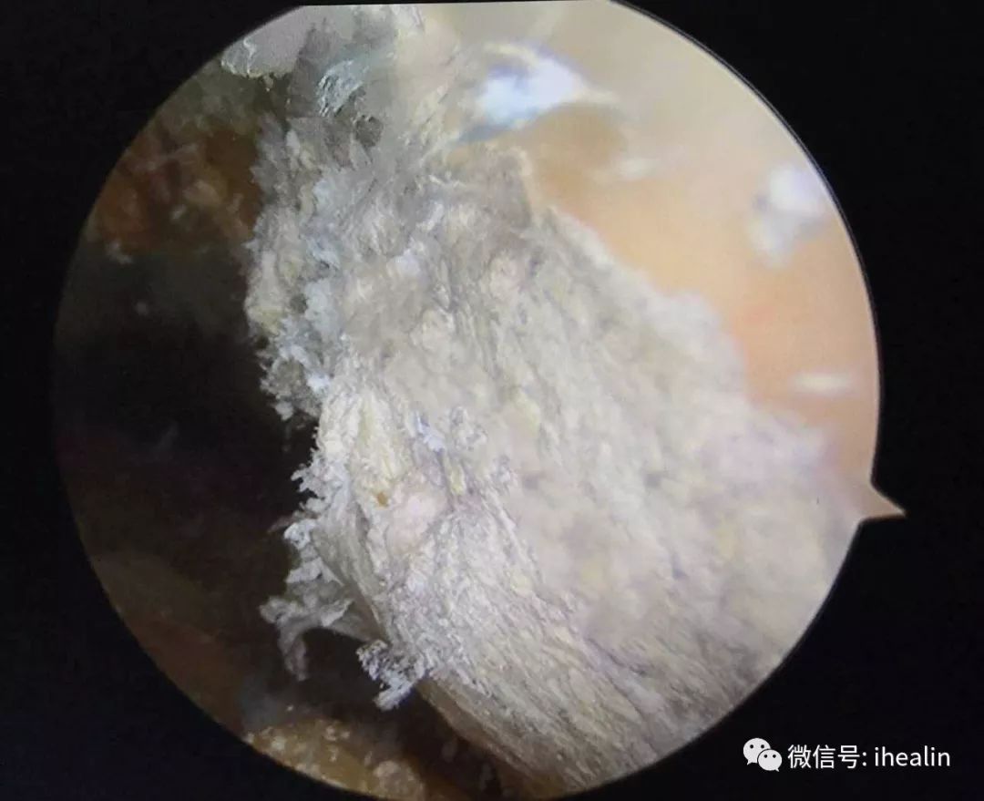 简单的说,就是人体代谢系统紊乱,代谢废物积累形成结石.