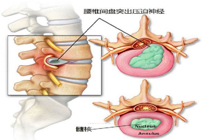 腰椎骨質增生給患者的身心都帶來了嚴重的影響,我們必須要及早的治療