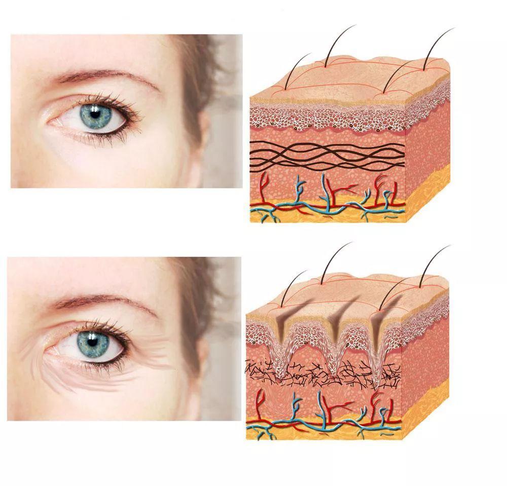 皱纹产生的真正原因,想做漂亮女人,你一定要知道的_凤凰网健康_凤凰