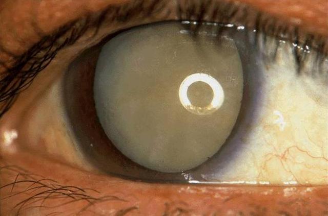 白内障专挑年轻人,白瞎了一双好眼