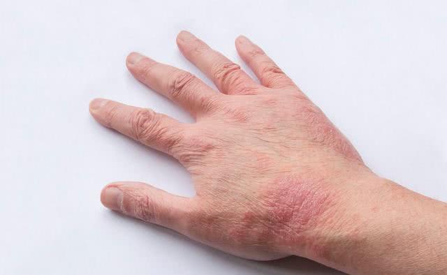 鱼腥动风之品,或嗜酒伤及脾胃,脾失健运,湿热内生,复感风湿热邪,内外