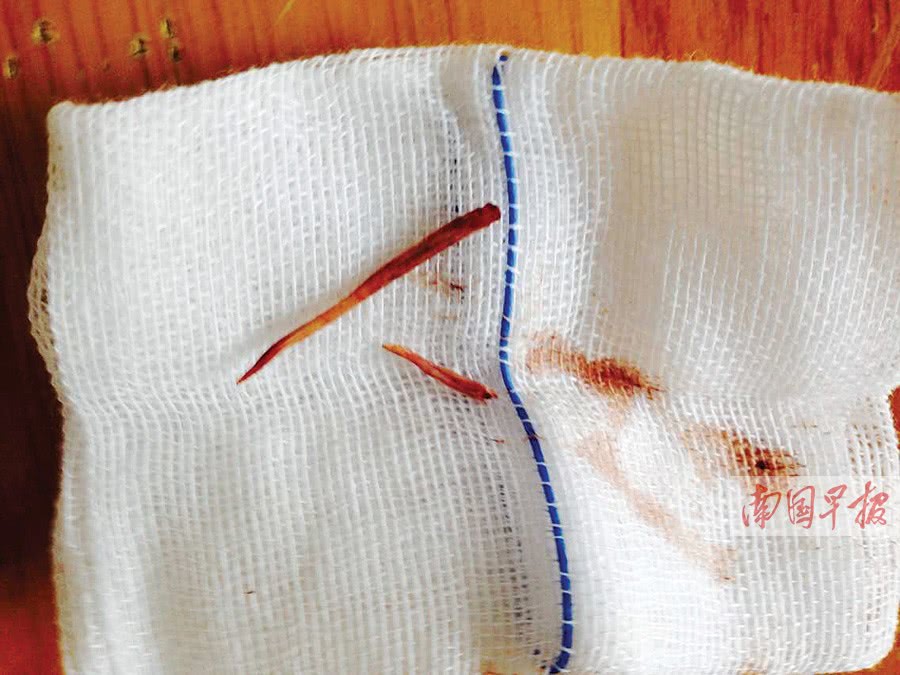 一根鱼刺引发"血案",真正遇到时,你该如何正确自救?