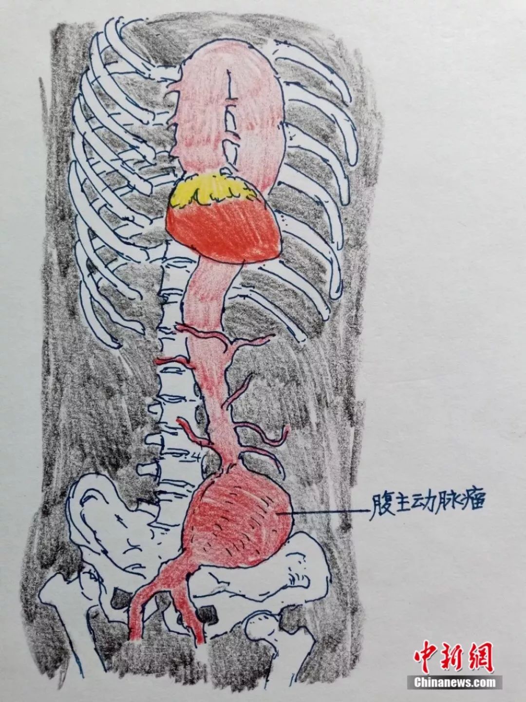 医生手绘漫画再现4小时极速营救