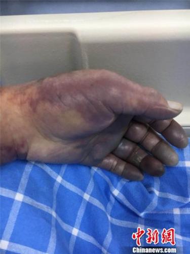 图为王大爷肿胀发黑的手.宁波市鄞州人民医院供图