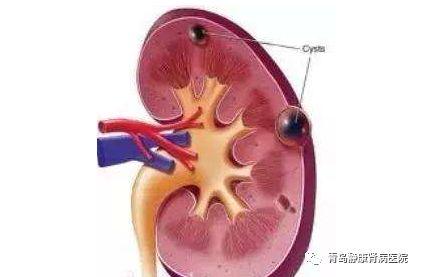 中医对多囊肾的认识,如何治疗多囊肾?