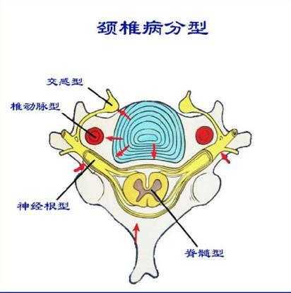 脊髓型颈椎病 颈椎后凸畸形 c6椎体血管瘤的术式 经典案例
