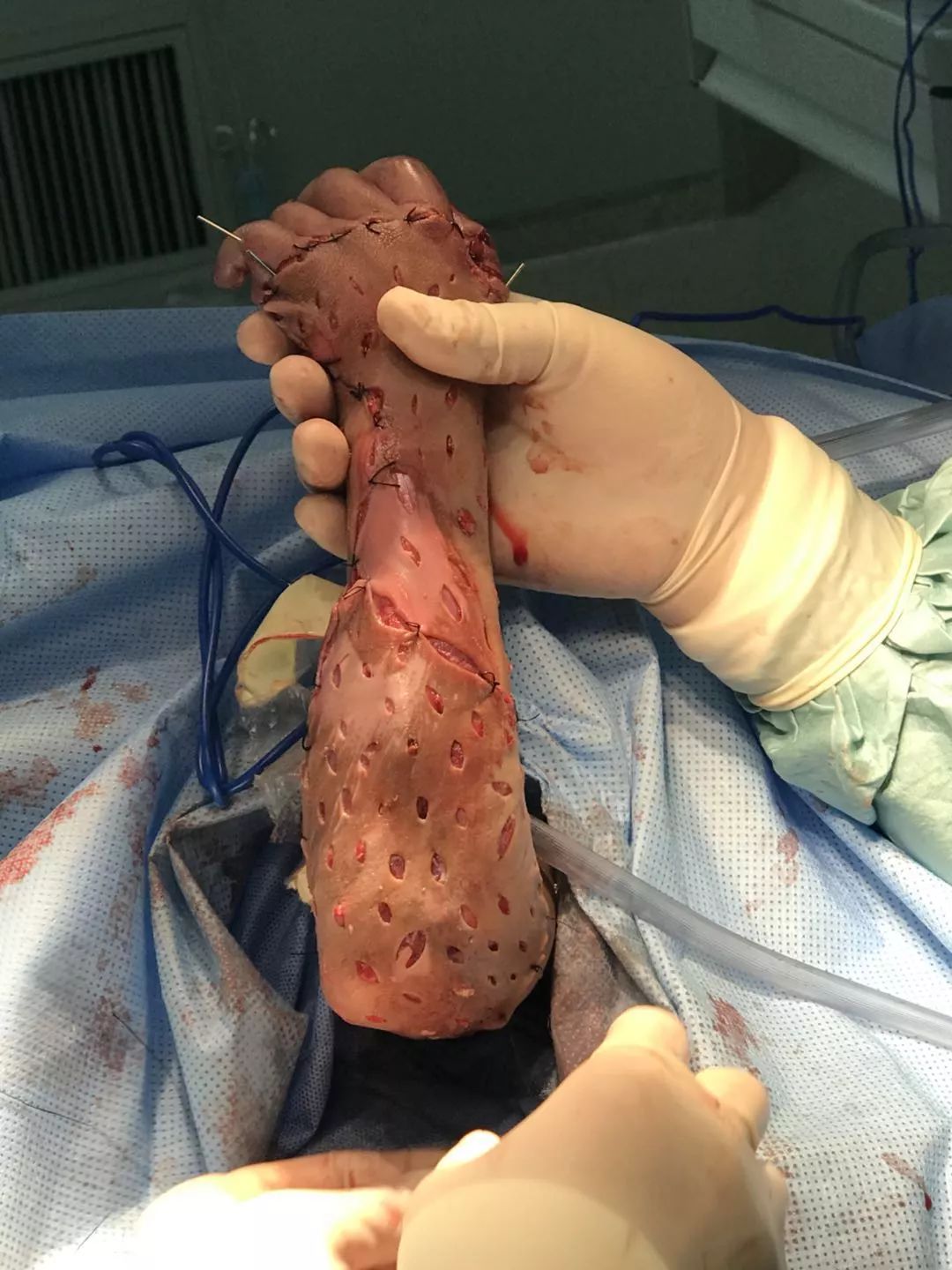 哈医大医者手术九小时,奋力为车祸孩子保住一条胳膊