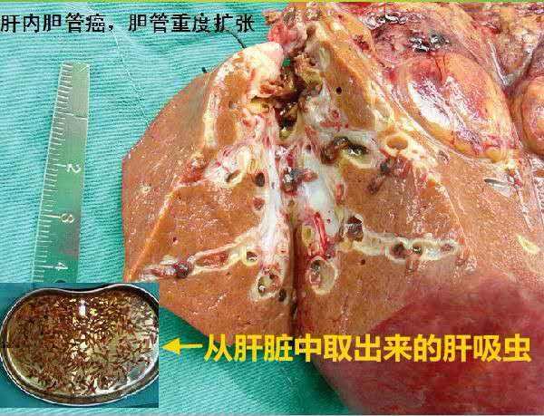 朱先生坦言,平常有吃生鱼片的习惯,之所以感染这种肝吸虫病,可能与该