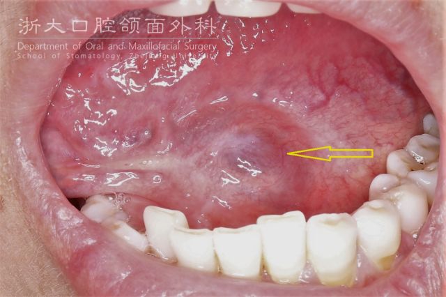 舌头根部长水泡图片