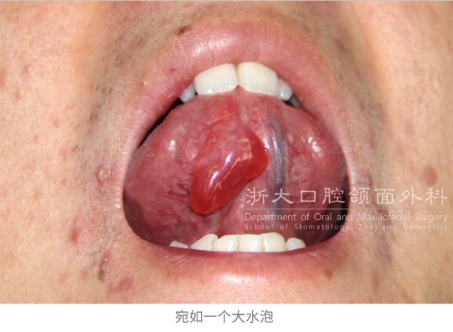 孩子舌下长水泡是不是肿瘤