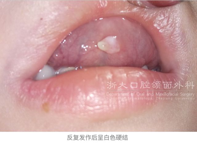 舌下襞和舌下阜图片图片