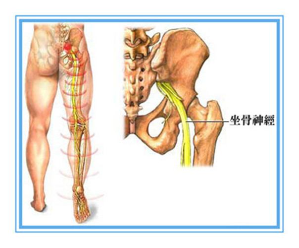 坐骨神经痛受折磨?3种锻炼4种治疗法