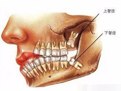 25岁男子被智齿捅破脸,造成严重困扰,智牙到底要不要拔!