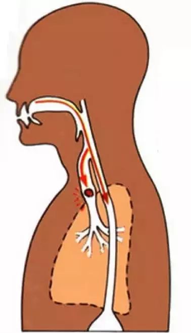如果食物进入气管,就会被呛到 | wordpress如果被呛到你觉得无碍,那