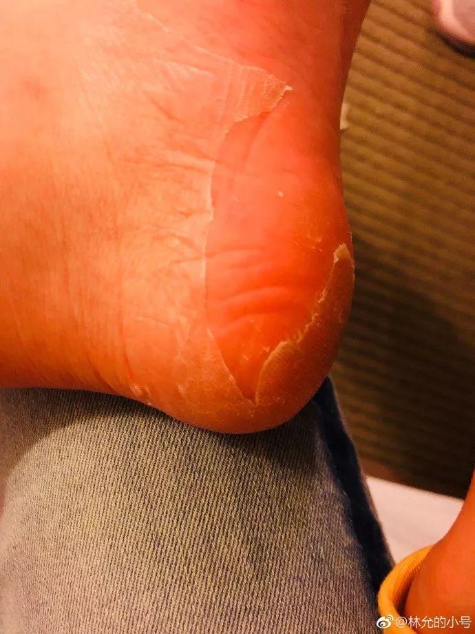 林允公开回应撕脚皮 配图确实如她所言简单粗暴