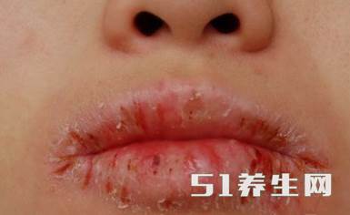 40年的老中医告诉你治疗烂嘴角只要俩招