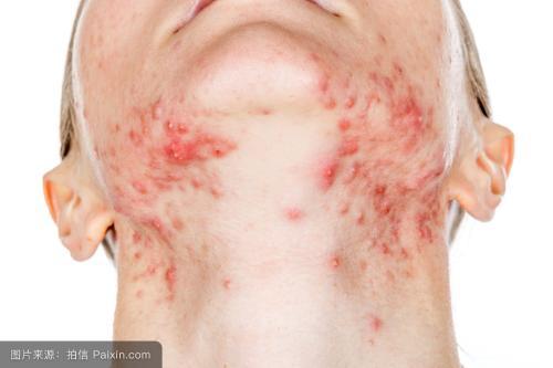 血糖一高,这5个症状立刻向你示警!一定要抓住啊