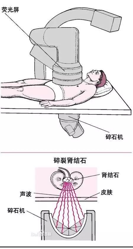 体外冲击波碎石示意图