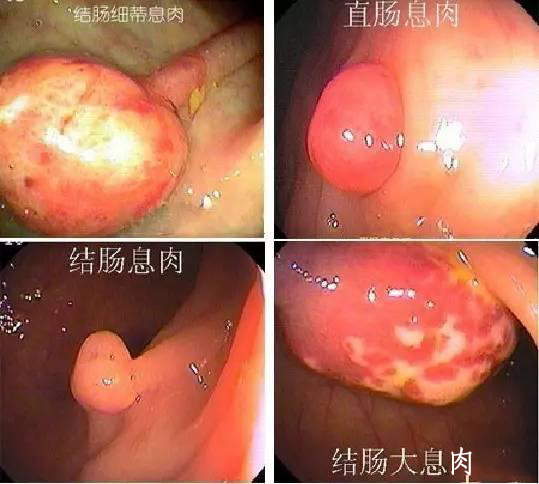 直肠乳头状腺癌图片