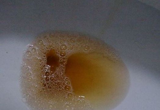 尿液是肾脏健康的指示灯若有2个特点可能肾出故障了