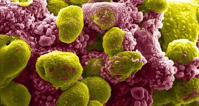 图|正在经历细胞凋亡的前列腺肿瘤细胞(红)与健康的癌细胞(黄)(图源