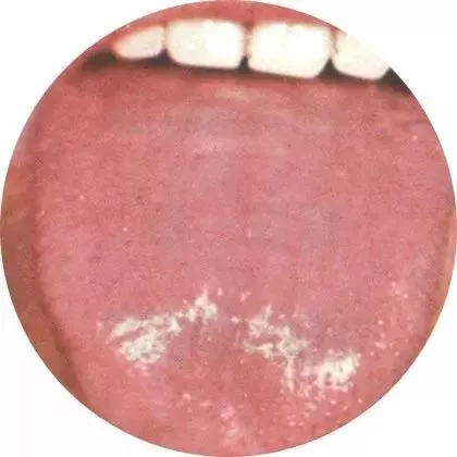 珍贵的舌诊图谱(收藏版)