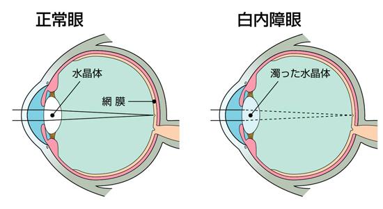 晶状体逐渐浑浊,不再清澈透明,也就是患白内障了,这是个不可避免和