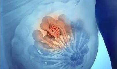 乳腺小叶增生的定义及分型预防办法 泰禾滋补秘方__凤凰网