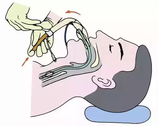 气管切开后,密切观察切口有无渗血.