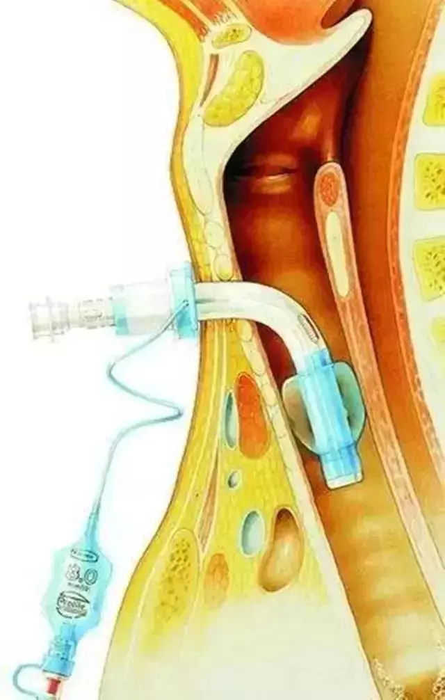 气管插管牙垫放置图片图片
