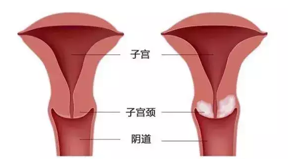 子宫变形: 正常子宫是由肌肉构成的中空的袋子,形状象一个倒放着的