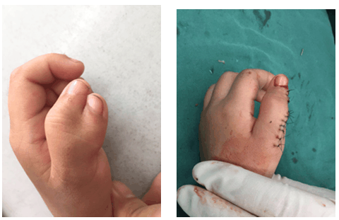 2岁男童天生六指隐约自知,小小心灵无处安放