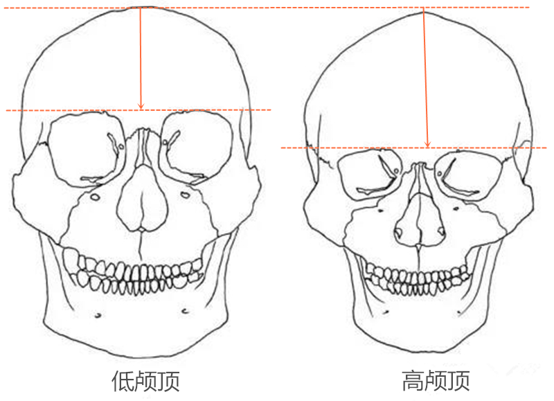 除了发际线的原因外,还有本身头颅骨的差异