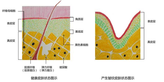 自由基的伤害,胶原纤维和弹性纤维生成减少,受损,硬化,断裂,真皮层