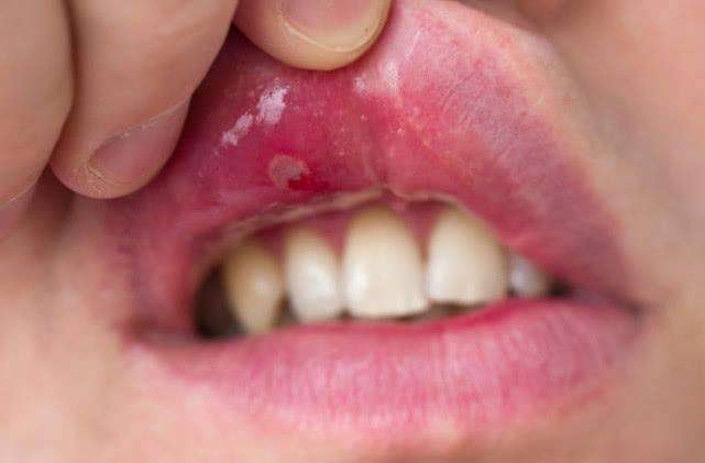 嘴巴长口疮, 除了上医院, 家用2个方法也能消, 坚持几天就没了