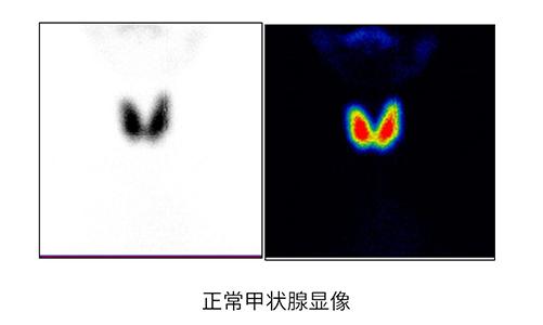 核素显像可显示甲状腺位置,大小,形态,放射性分布状况.