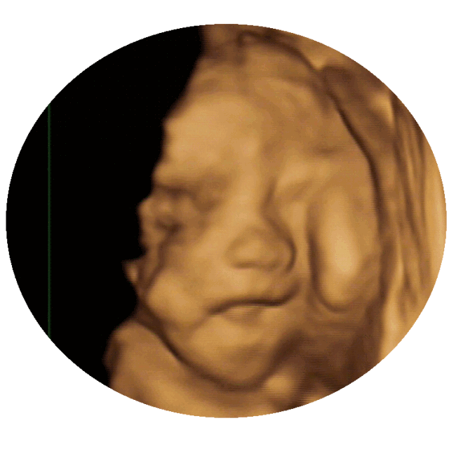 做超声影像时,胎宝宝老趴着怎么办?__凤凰网